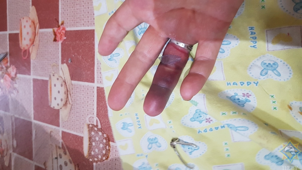 Гомельские спасатели помогли пенсионерке снять кольца с отекшего пальца